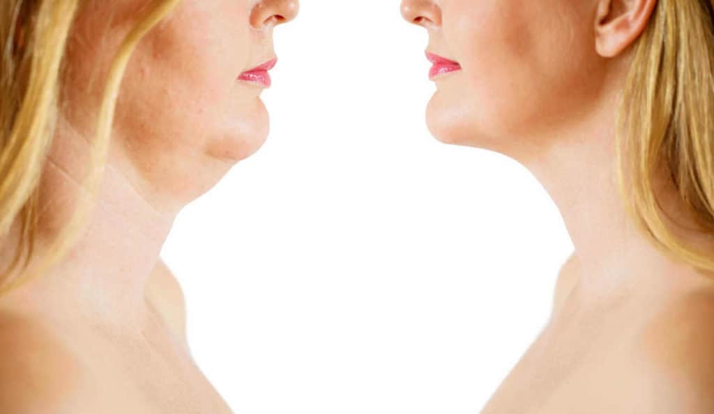 Double Chin treatment Sandbach before and after results