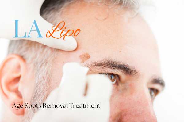 What Are the Most Effective Treatments for Age Spots Sandbach?