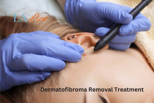 Dermatofibroma Removal Treatment Sandbach