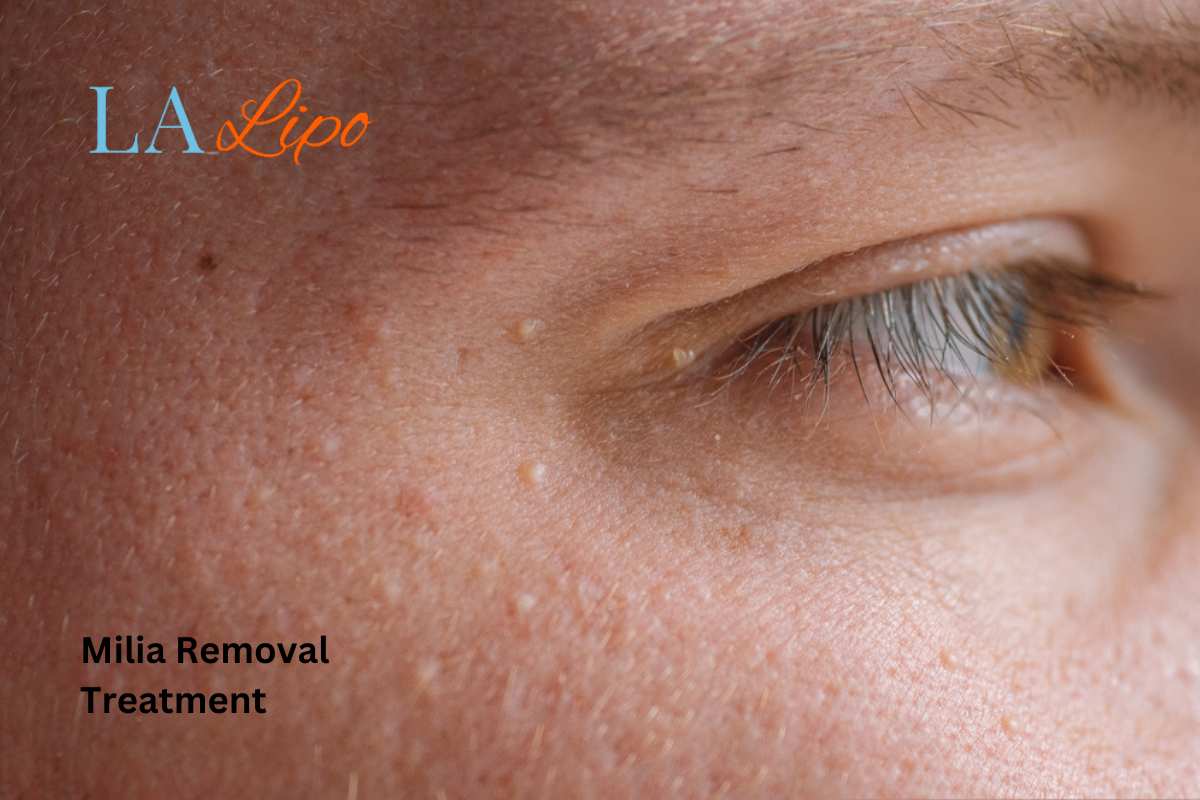 Cryopen Milia Removal: Is It the Easiest and Safest Option Sandbach?