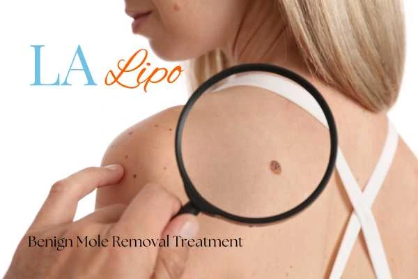 Woman having her inspection of blemish before mole removal Sandbach