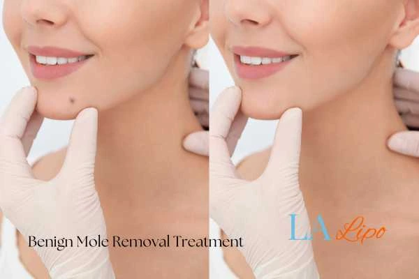 Before and after mole removal Sandbach treatment