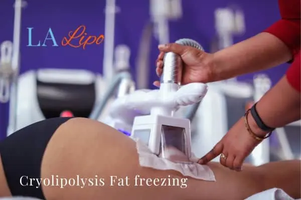 women getting fat freezing Sandbach