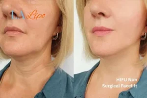 hi-fu for wrinkles Sandbach before and after results