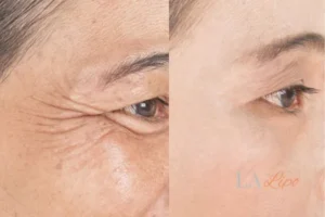Before and after results of woman - HI-fu wrinkles reduction treatment Sandbach