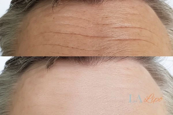 results of HIFU Sandbach on mans forehead to help reduce lines and wrinkles