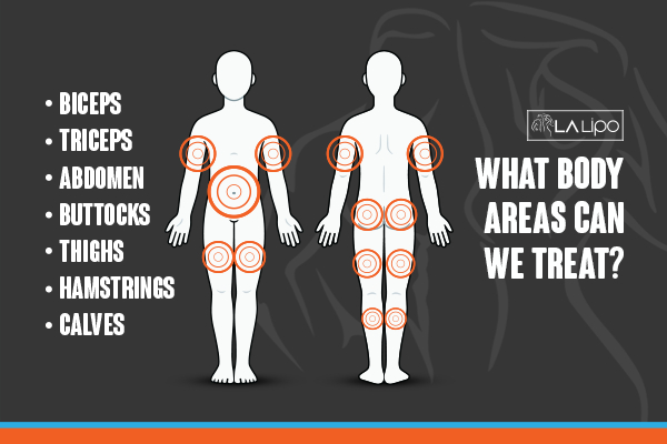 Graphic to show areas you can have LA-EMS Body Sculpting Sandbach treatment.