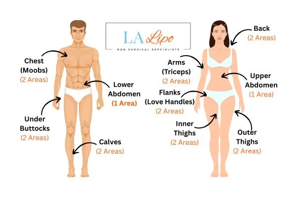 LA LIPO Cryolipolysis Areas Sandbach