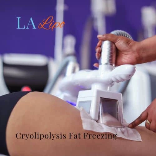 fat freezing - Cryolipolysis Sandbach