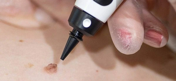 skin tag removal using cryopen Sandbach