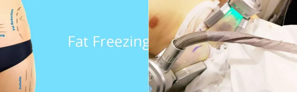 multi areas of a persons body having coolsculpting Sandbach treatment