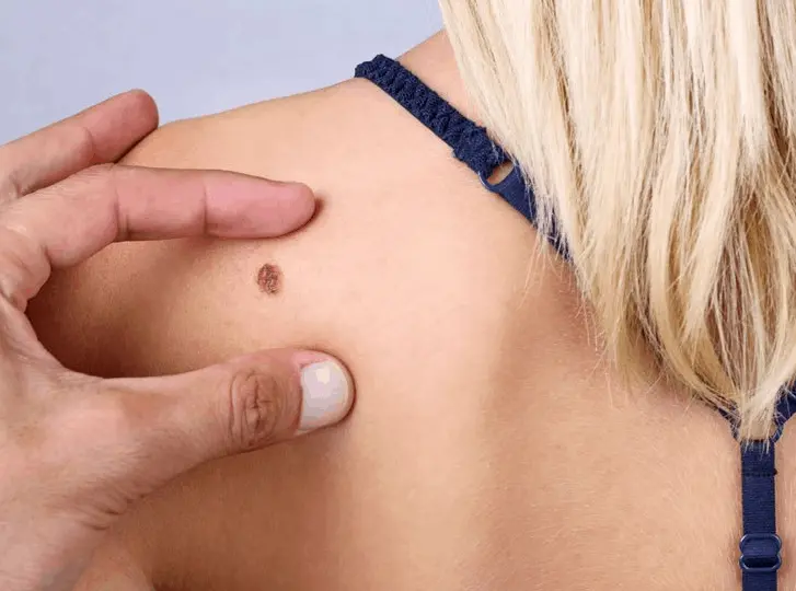 woman having mole removal Sandbach consultation before treatment.