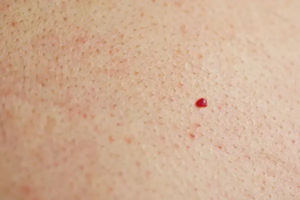 close up of a cherry angioma Sandbach