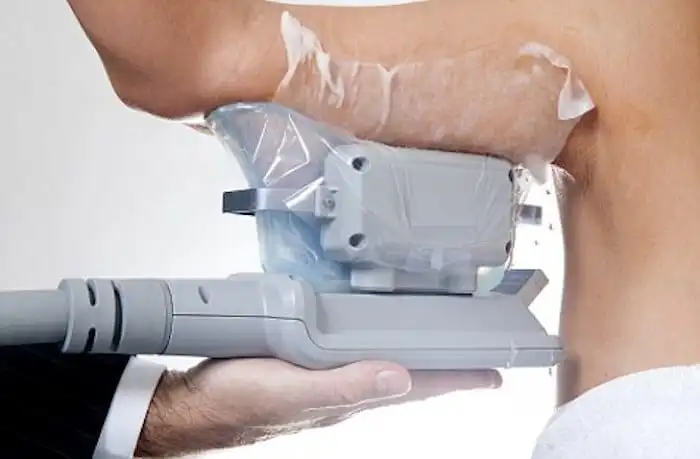 Picture of fat freezing Sandbach on the upper arms.