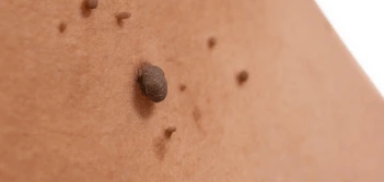 image of a skin tag Sandbach