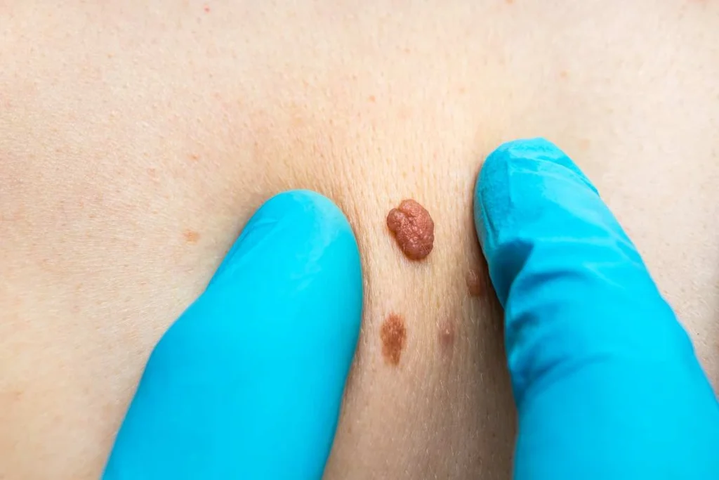 Consultant examining a skin tag Sandbach