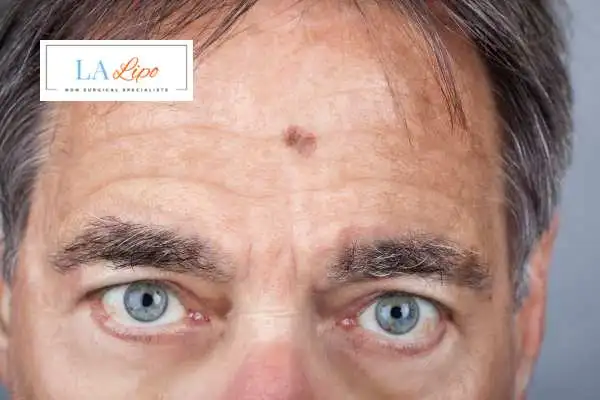 Solar Lentigo Removal Sandbach image of man with mark on his forehead