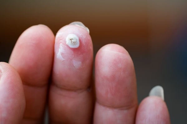 wart on person finger - cryotherapy to treat from LA LIPO Sandbach