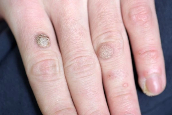 photo of warts on person hand - see wart removal Sandbach from LA LIPO