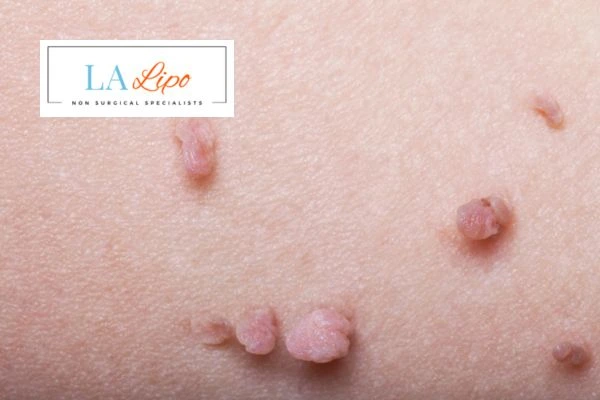 Does cryopen skin tag removal Sandbach hurt? Find out now call our team today!