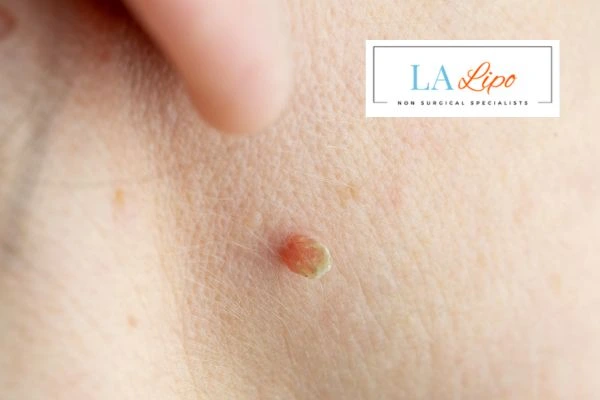Book skin tag removal Sandbach today speak to our team now!