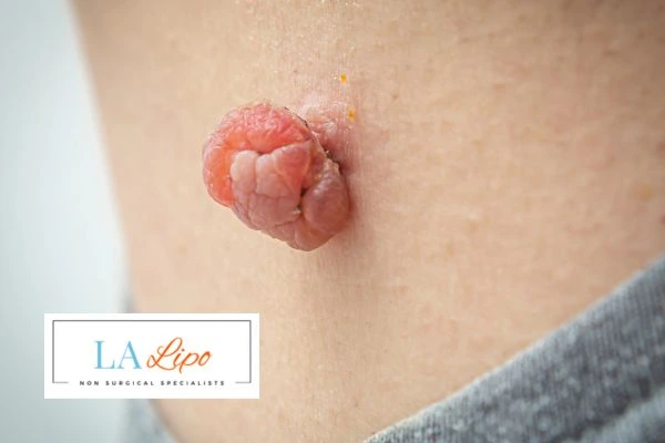 Interested in skin tag removal Sandbach? Concerned about the pain? Find out more today!