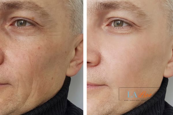 See the amazing results of Morpheus8 Treatment Sandbach!