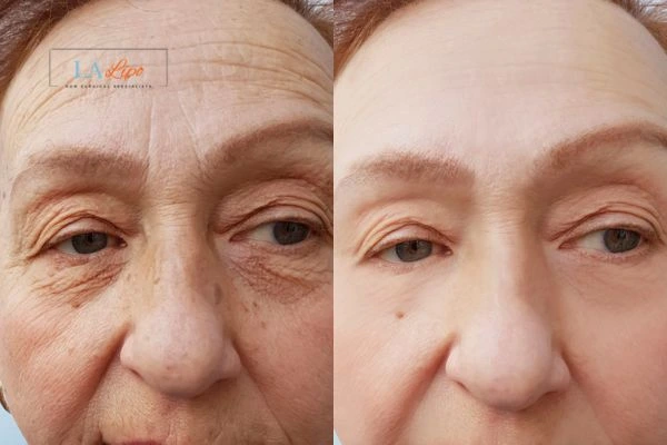 The powerful benefits of Morpheus8 Treatment Sandbach - Call Our team today!