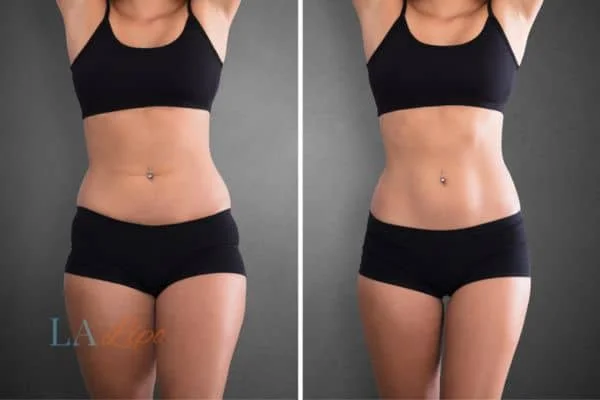 before and after results of non-surgical treatment to help a woman's body image and mental health Sandbach