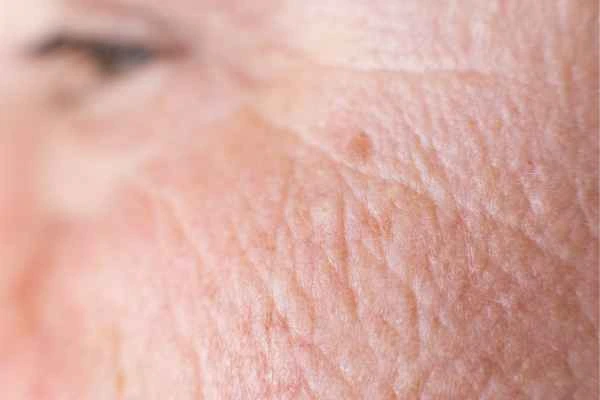 close up picture of a woman's face showing an age spot Sandbach