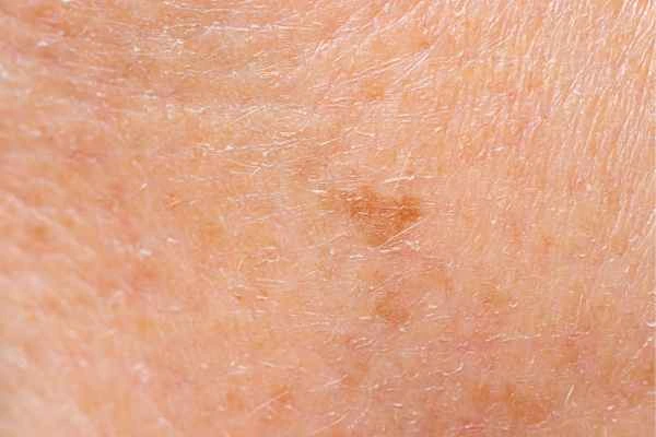 close up picture of age spots Sandbach
