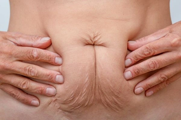 Image of a woman's stomach with loose skin - example of skin tightening Sandbach options
