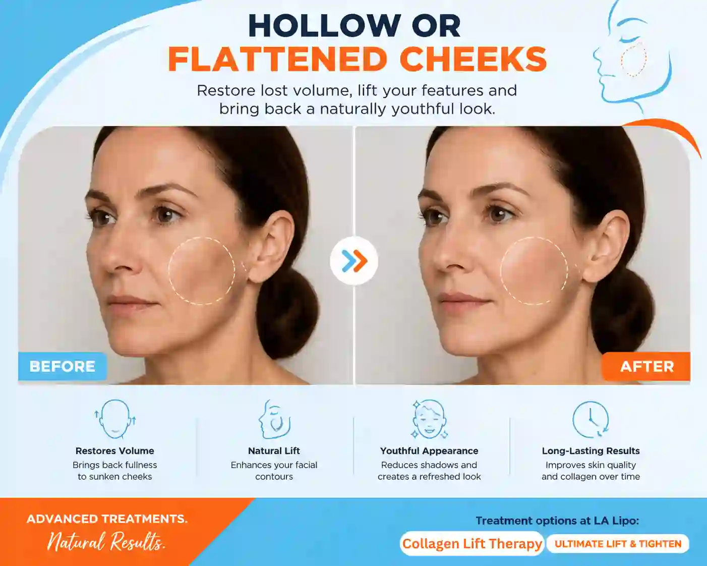 Sign #4: Hollow or Flattened Cheeks Sandbach